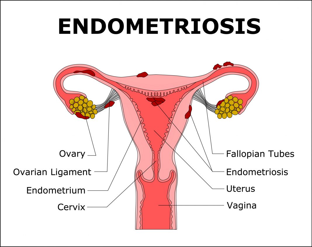 Symptoms Of Endometriosis Thisisendometriosis