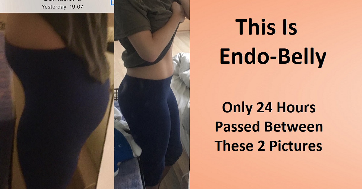 endo belly bloating