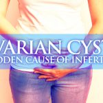 Ovarian Cysts A Sudden Cause of Infertility