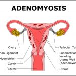 Adenomyosis-1