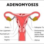 Adenomyosis