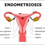 Endometriosis-1