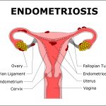 Endometriosis