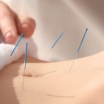 woman-acupuncture2