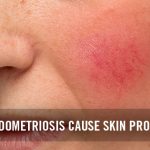 Can Endometriosis cause skin problems