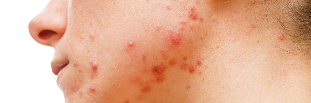 endometriosis woman acne